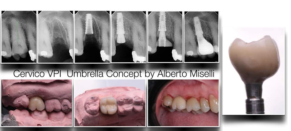 ZERO BONE LOSS by Alberto Miselli