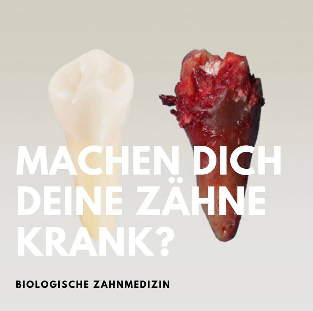 Gesunder Zahn vs. Wurzelbehandlung