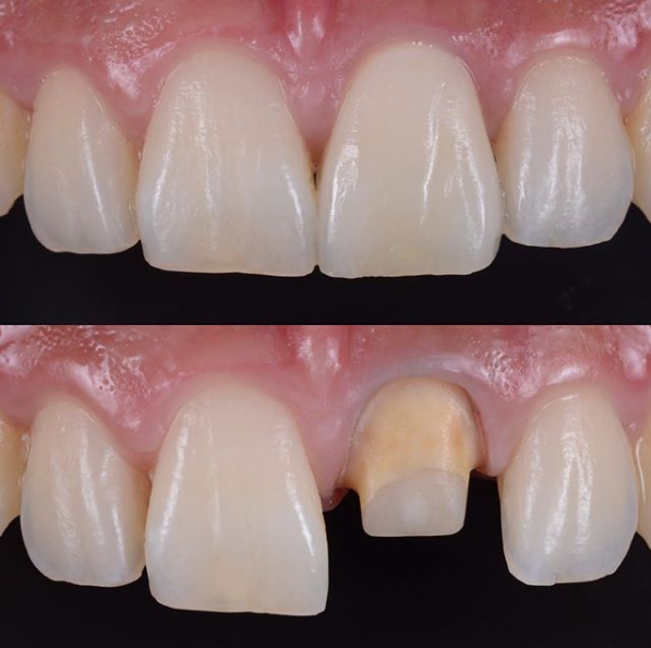 Zirconia Crown
